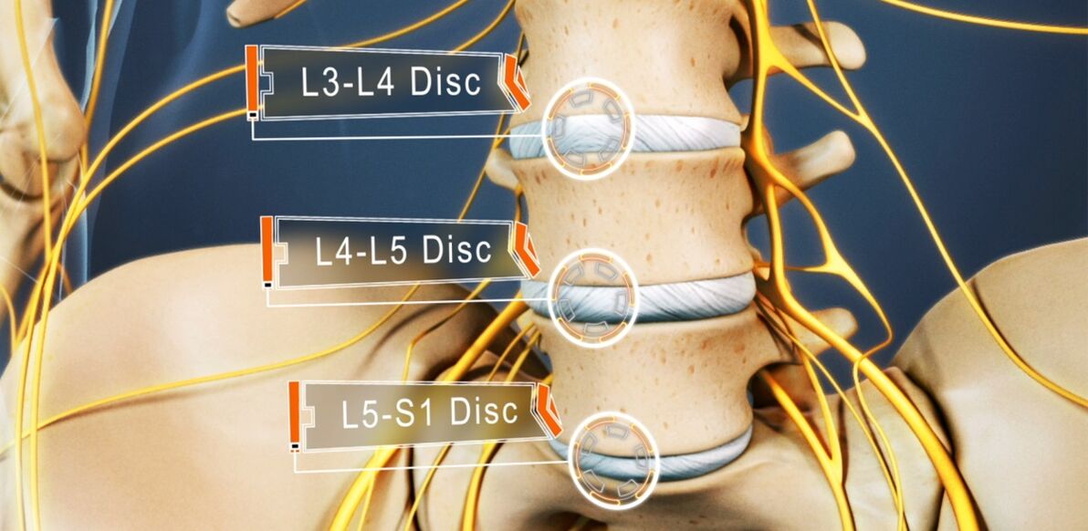 Discs of the lumbar spine, which are most often affected by osteochondrosis