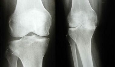 Knee diagnostic methods