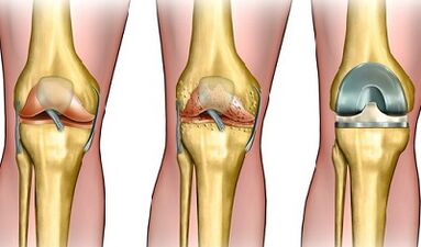 The degree of development of osteoarthritis of the knee joint