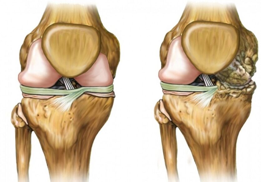 Knee osteoarthritis