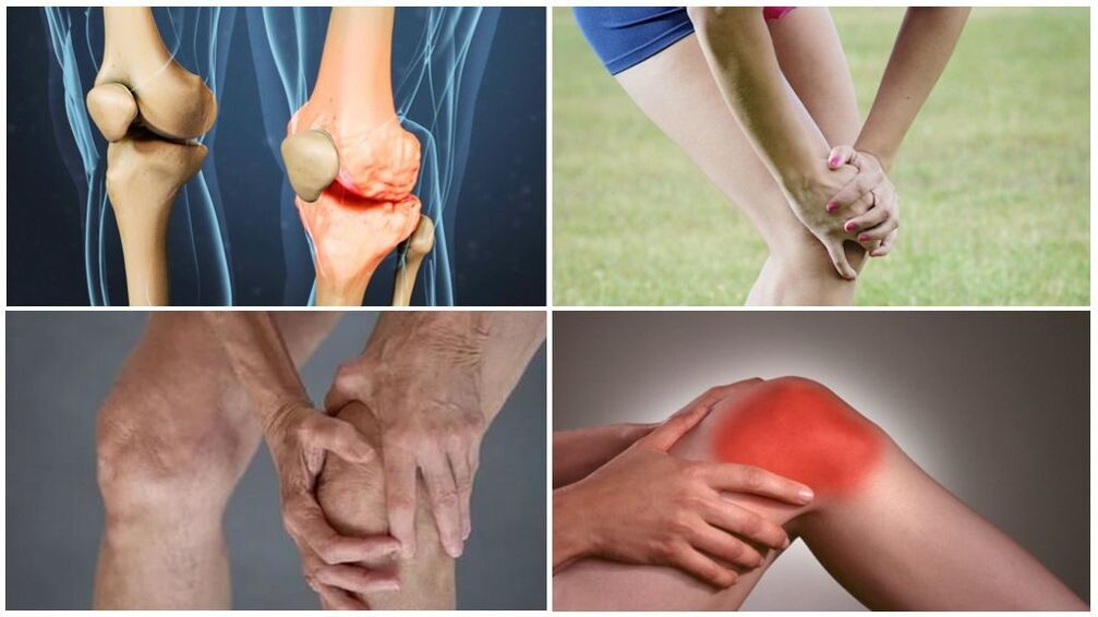 Osteoarthritis stages