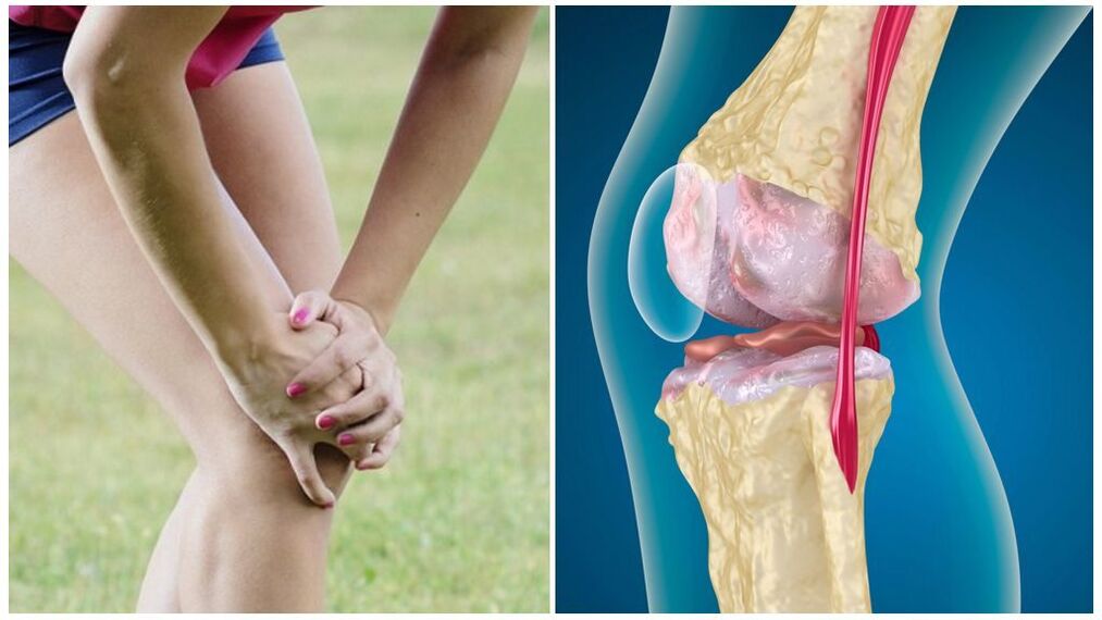 Osteoarthritis