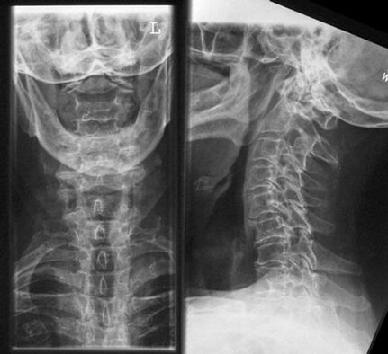Cervical X -Ray - Osteochondrosis diagnostic method