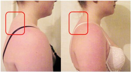 Muscle roller formation with cervical osteochondrosis