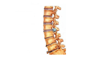 Damage to the spine with cervical osteochondosis