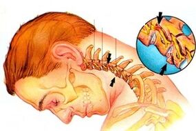 Pinching of the nerve in the spine with cervical osteochondosis