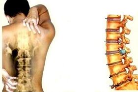 back pain at different stages of the development of cervical osteochondrosis