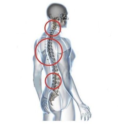 sites of spinal osteochondrosis