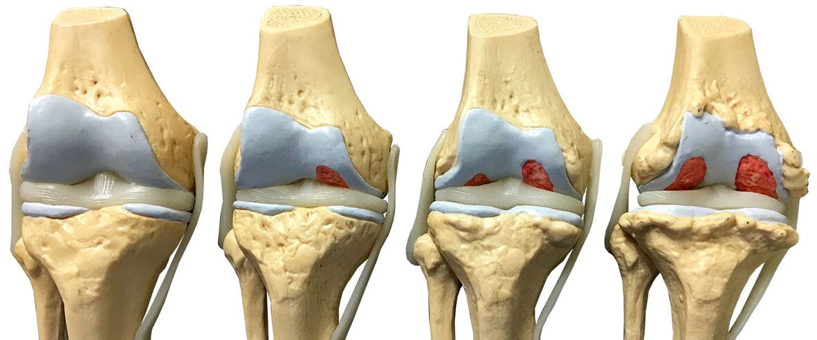 stages of osteoarthritis