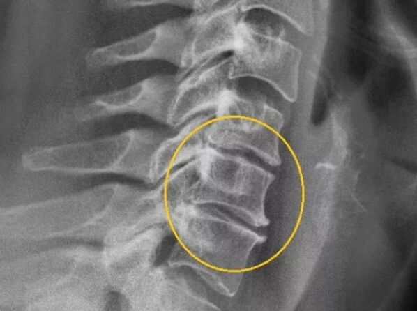 Osteochondrosis of the cervical spine on radiography